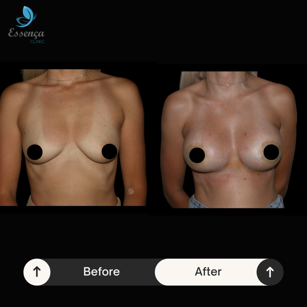 Before and After Result